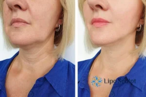 Double chin before and after Hi-Fu treatment 4 Book your double chin treatment Central Milton Keynes today! We are here to help!