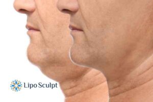 Double chin before and after Hi-Fu treatment 2 Double chin treatment Central Milton Keynes from Lipo Sculpt - feel more confident today!