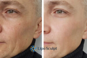 How to Fight Aging Symptoms 3 Fight Aging Symptoms Central Milton Keynes With HIFU and Morpheus8 Today!