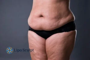 Cellulite's 5 Most Common Causes 4 Feel more confidence with your cellulite Central Milton Keynes treatment today!