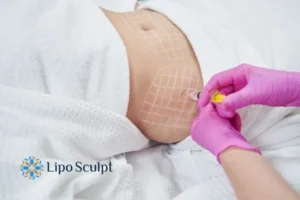 Are The Results From Aqualyx Permanent? 1 Do you want to know how long Aqualyx Central Milton Keynes results last?