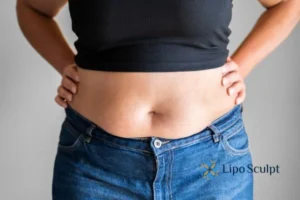 Bidding Farewell to Muffin Tops with Aqualyx Fat Injections 2 Do you wish you could reduce your muffin top Central Milton Keynes With Aqualy fat dissolving injections you can!
