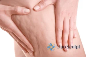 CoolSculpting for Legs: The Innovative Approach to Redefining Your Legs 5 Start your journey today book your coolsculpting treatment Central Milton Keynes online today!